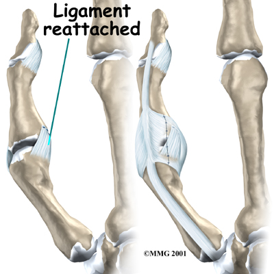Ulnar Collateral Ligament. repairs the ligaments with