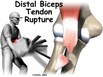 bicep tendons