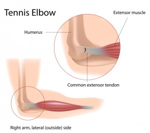 What is Tennis Elbow (Lateral Epicondylitis) 1