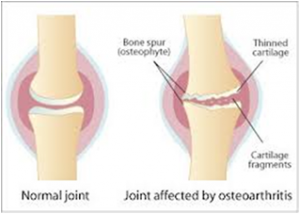 Osteoarthritis: Can physiotherapy help?